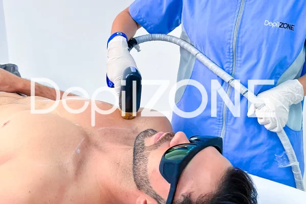Explorando la durabilidad de la depilación laser ¿Es permanente?